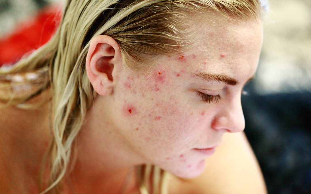 Effective Acne Solutions for Healthy and Radiant Skin